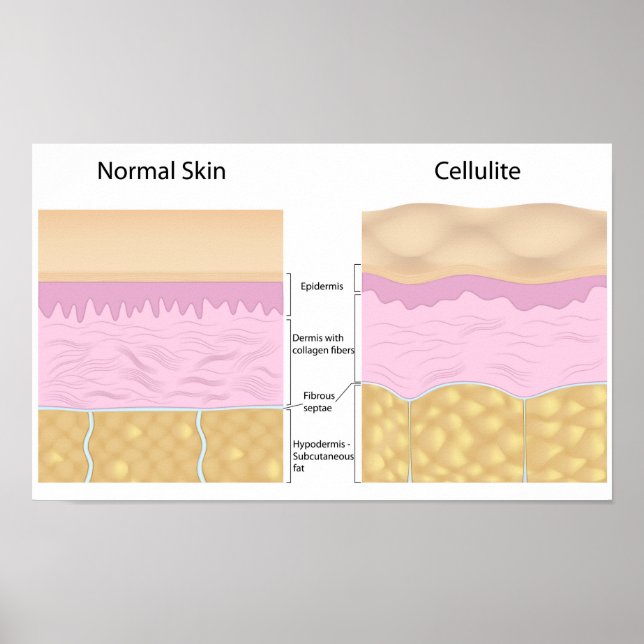 Skin cellulite  Poster (Front)