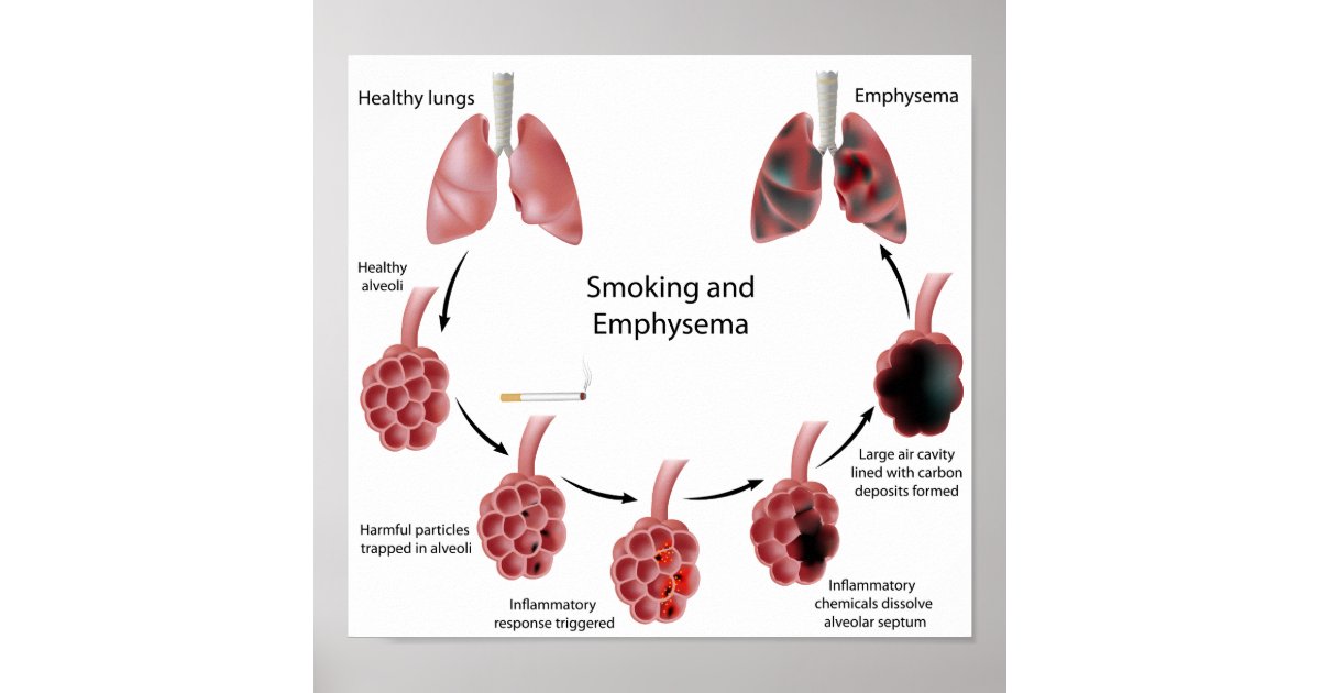 Smoking and emphysema Poster | Zazzle