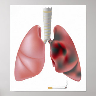 Smoking and lung cancer Poster