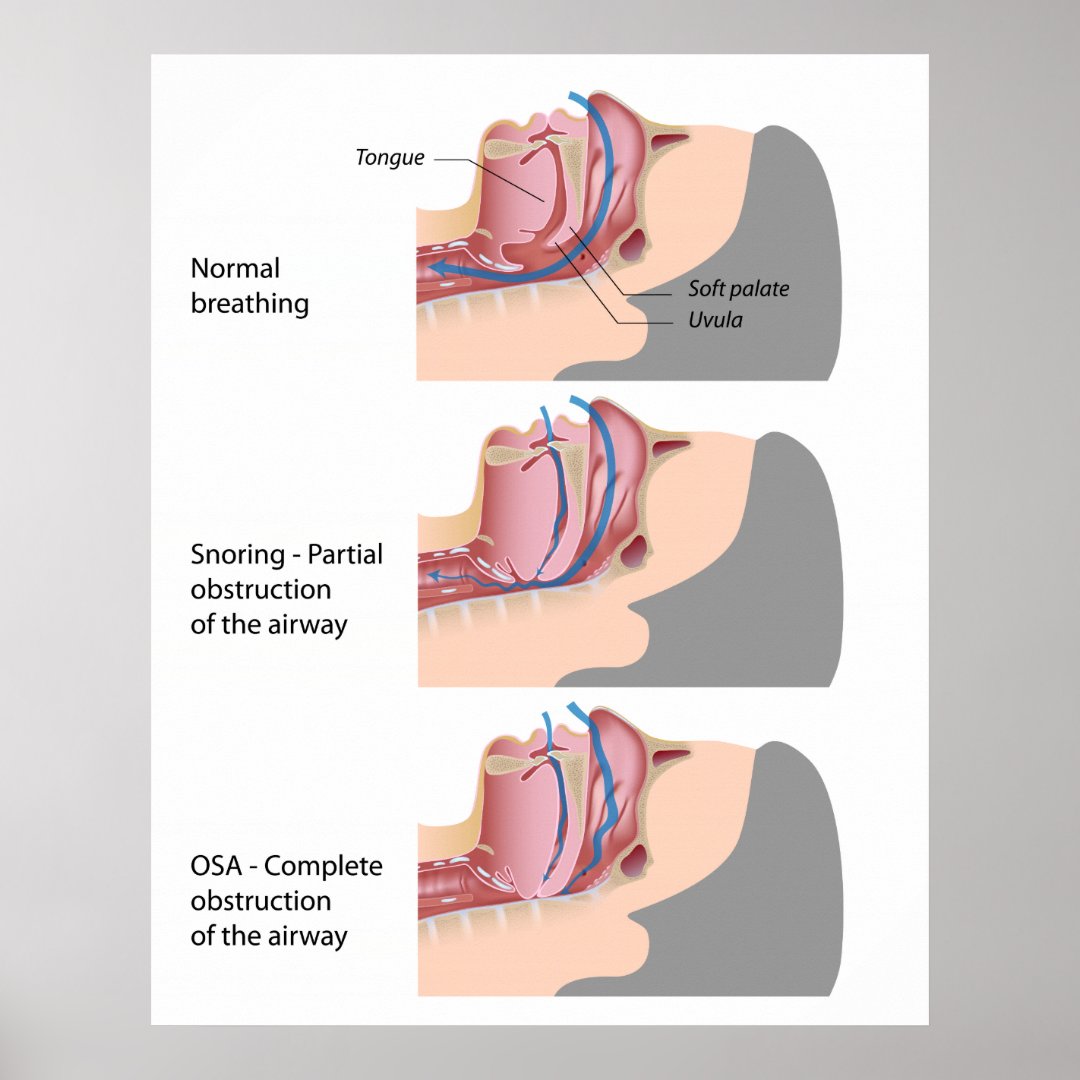 Snoring and sleep apnea Poster | Zazzle