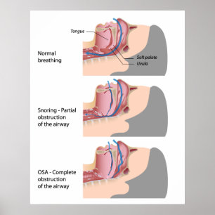 Snoring and sleep apnea Poster