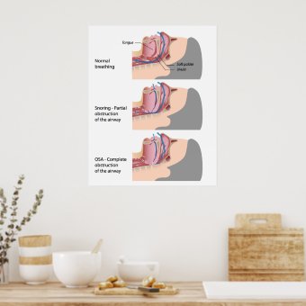 Snoring and sleep apnea Poster | Zazzle