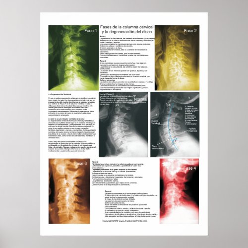 Spanish Phases Cervical Spinal Degeneration Poster