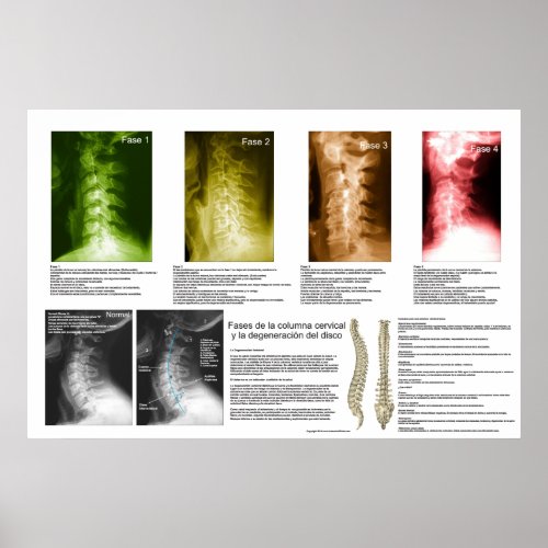 Spanish Phases Cervical Spinal Degeneration Poster