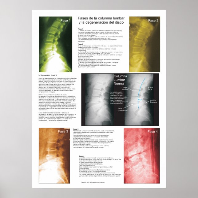 Spanish Phases Lumbar Spinal Degeneration Poster (Front)