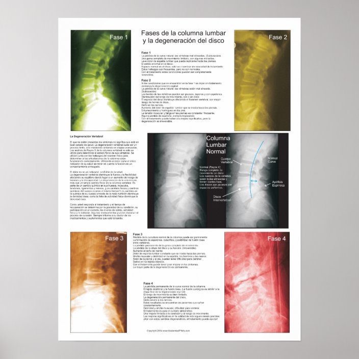 Spanish Phases Lumbar Spinal Degeneration Poster Zazzle