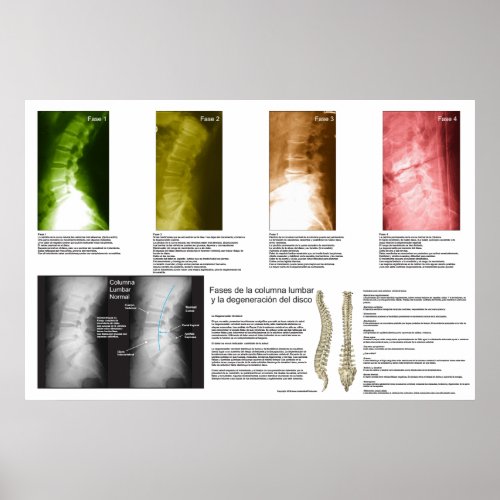 Spanish Phases Lumbar Spinal Degeneration Poster
