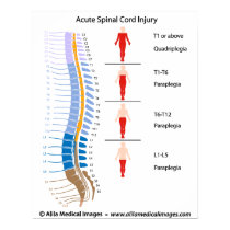 Spinal cord injury levels, labeled diagram. poster