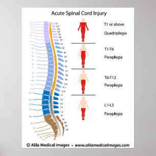 Spinal cord injury levels, labeled diagram. poster