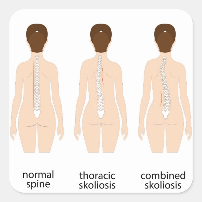 Spinal deformity square sticker (Front)