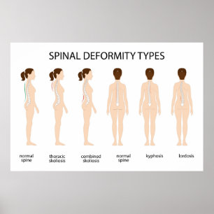 Spinal deformity types poster