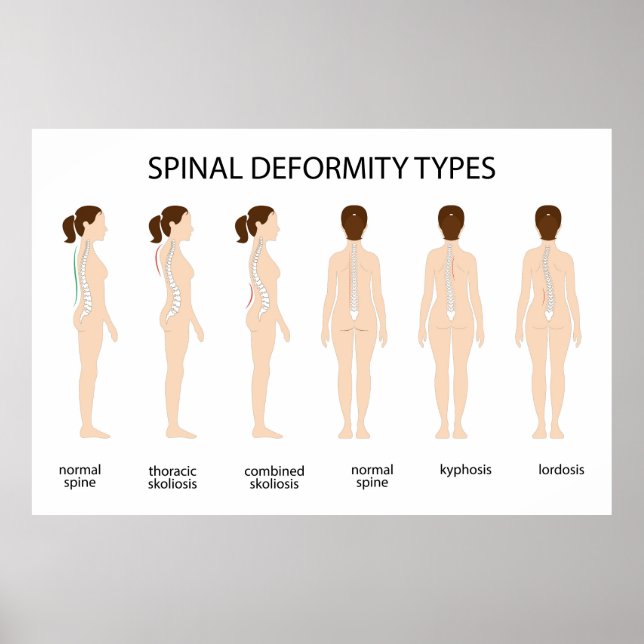 Spinal deformity types poster (Front)