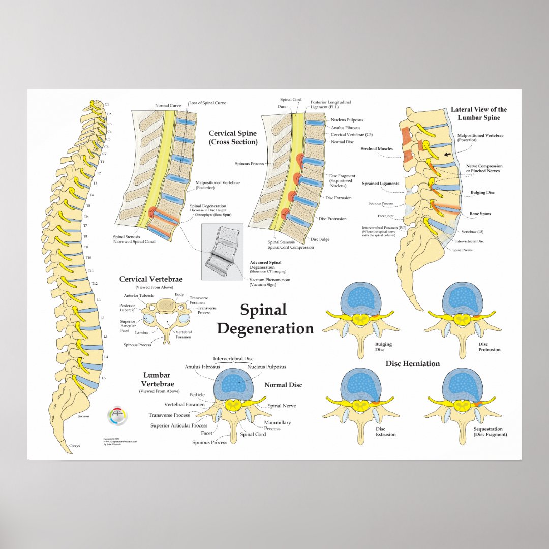 Spinal Degeneration Disc Herniation Poster | Zazzle