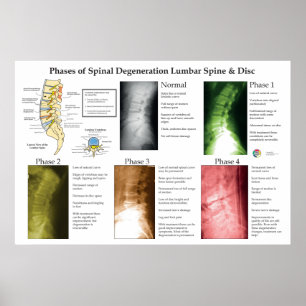 Spinal Degeneration Lumbar Spine Chiropractic Poster