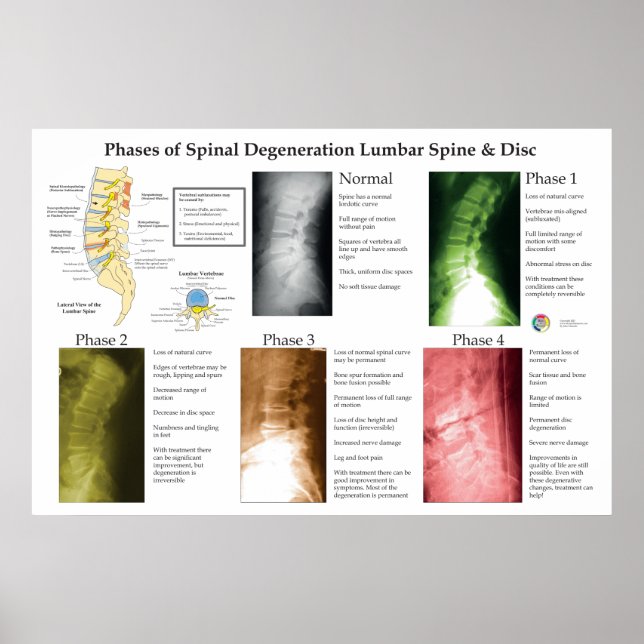 Spinal Degeneration Lumbar Spine Chiropractic Poster (Front)