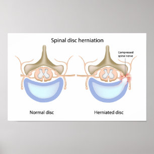 Spinal disc herniation Poster