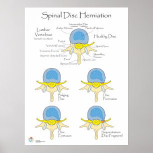 Spinal Disc Herniation Poster Medical Poster