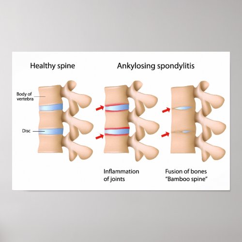 Spine Ankylosing spondylitis Poster