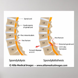 Spondylolysis and spondylolisthesis, labeled poster