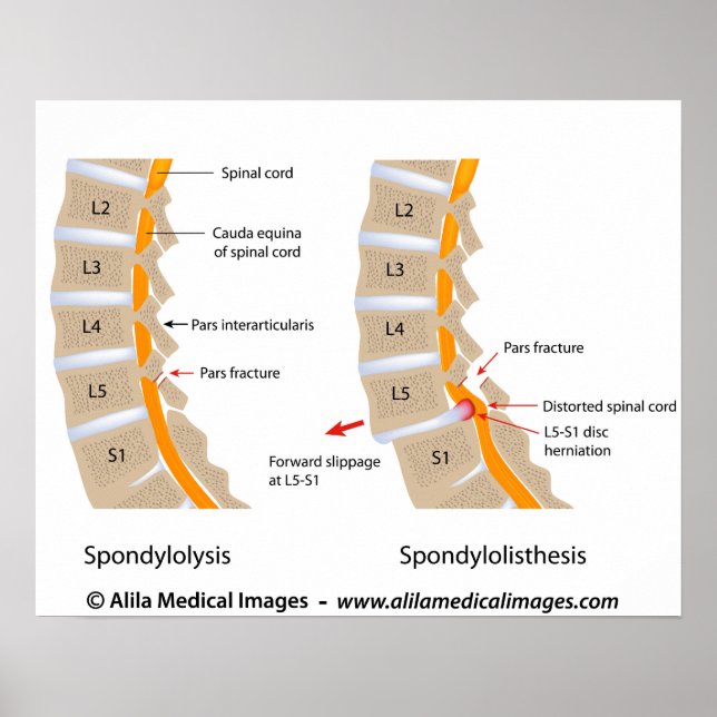 Spondylolysis and spondylolisthesis, labeled poster (Front)