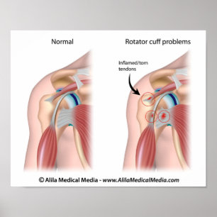 Sport injury shoulder impingement Poster