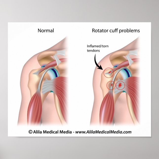 Sport injury shoulder impingement Poster (Front)