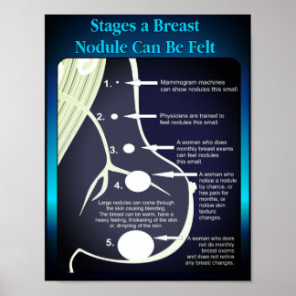 Stages A Breast Nodule Can Be Felt Poster