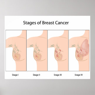 Stages of Breast Cancer Poster