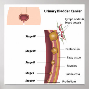 Stages of urinary bladder cancer Poster