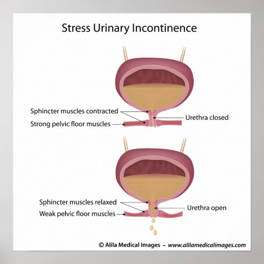 Stress urinary incontinence in women. poster | Zazzle.com