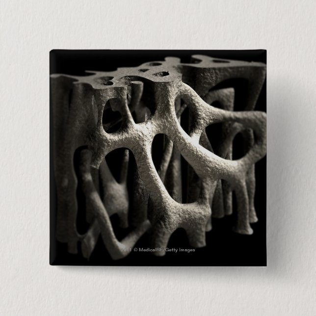 Structure of a bone with osteoporosis pinback button (Front)