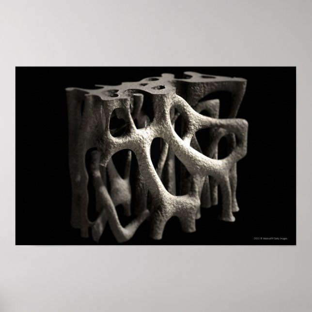 Structure of a bone with osteoporosis poster (Front)
