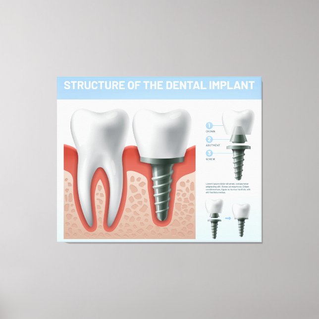 Structure of the Dental implant Canvas Print (Front)