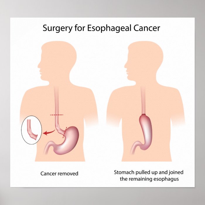 Surgery for esophageal cancer Poster