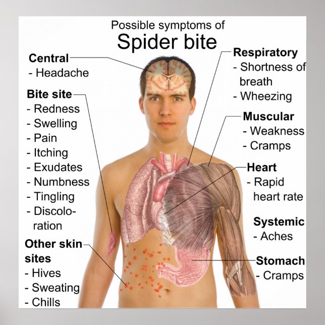 Symptoms Common in Poisonous Spider Bites Chart (Front)
