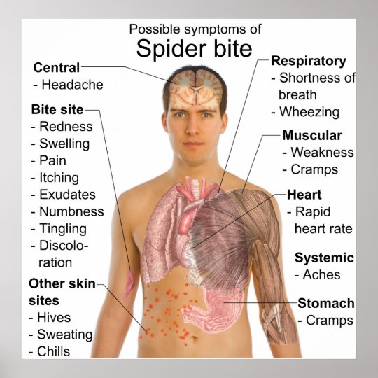 Symptoms Common in Poisonous Spider Bites Chart Poster Zazzle