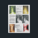 Tear Off Pad Cervical Spinal Degeneration<br><div class="desc">Radiology views of the cervical spine showing the 4 phases of spinal degeneration. Color coded to help explain xrays during report of findings with your patient. Common conditions are listed with each phase. Patient education handout for the chiropractic clinic.</div>