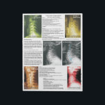 Tear Off Pad Subluxation Cervical Degeneration<br><div class="desc">Radiology views of the cervical spine showing the 4 phases of subluxation degeneration. Color coded to help explain xrays during report of findings with your patient. Common conditions are listed with each stage of degeneration. The rate of spinal decay is noted with the phases of spinal degeneration. This is an...</div>