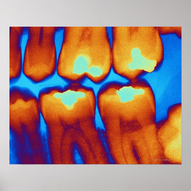 Teeth with fillings (green), colored X-ray. Poster (Front)