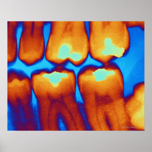 Teeth with fillings (green), coloured X-ray. Poster
