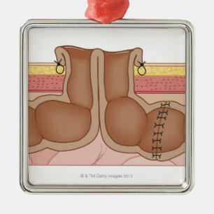 Temporary Colostomy Metal Ornament