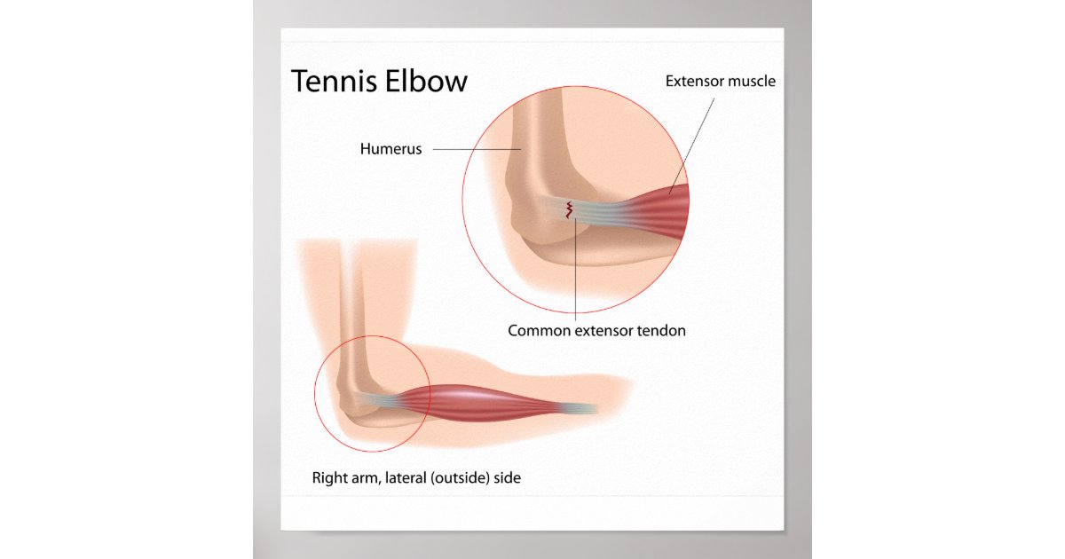 Tennis elbow Sport injury Poster | Zazzle