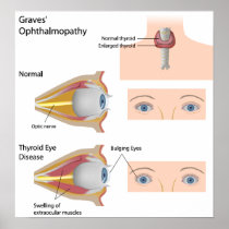 Thyroid eye disease Poster