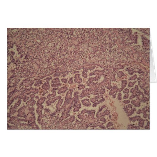 Thyroid gland cells with cancer cards (Front Horizontal)