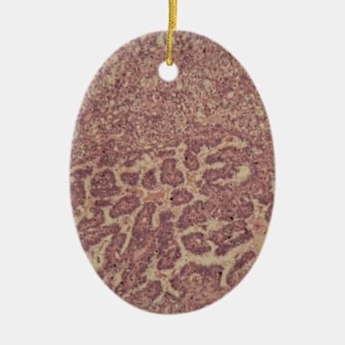 Thyroid gland cells with cancer ceramic ornament