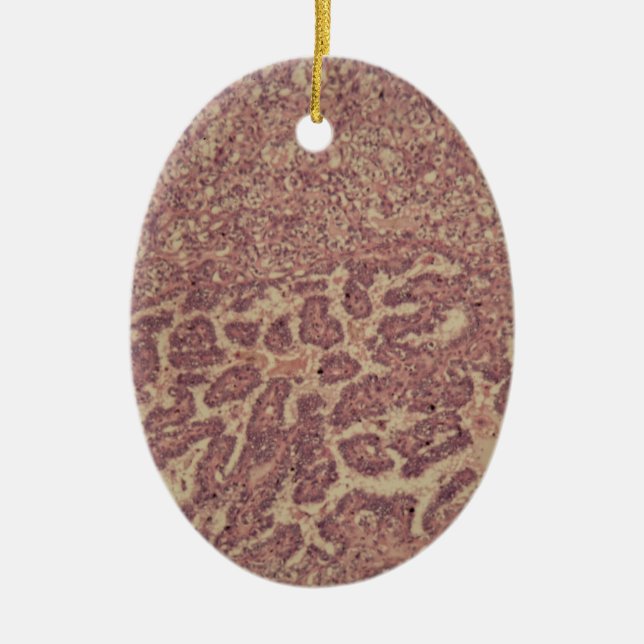 Thyroid gland cells with cancer ceramic ornament (Front)