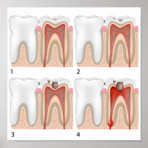 Tooth decay Poster