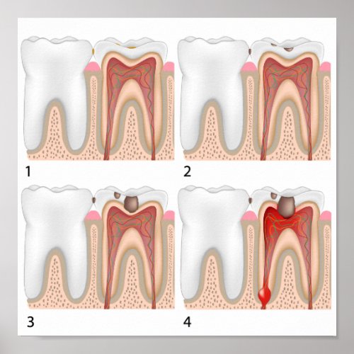 Tooth decay Poster