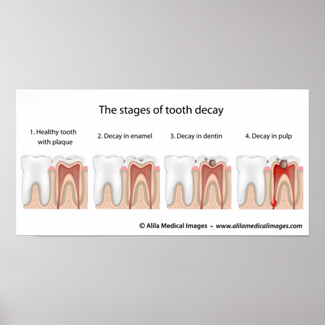Tooth decay Poster (Front)