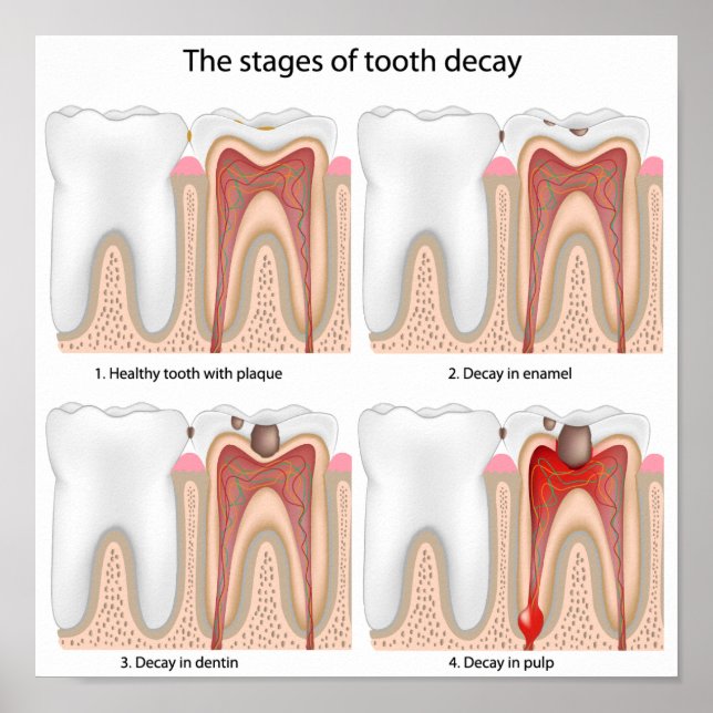 Tooth decay Poster (Front)